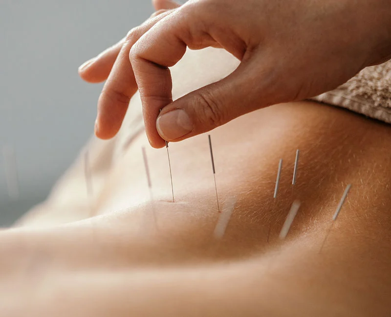 Just What Is Acupuncture All About? What Should I Expect?